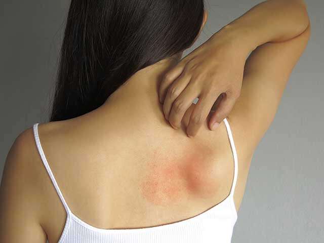inflammation