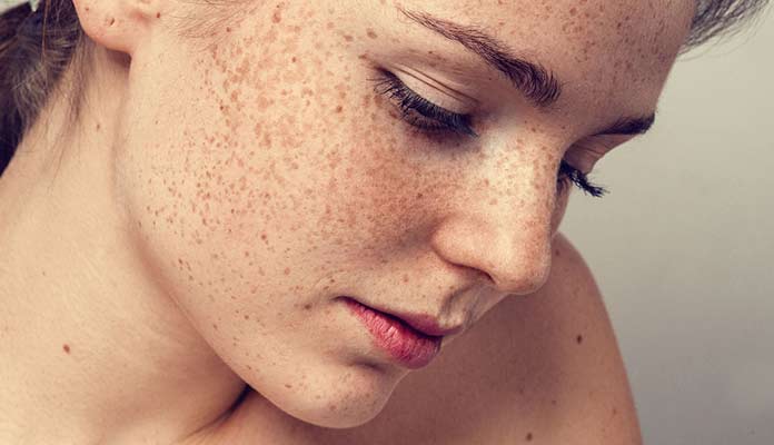 melasma