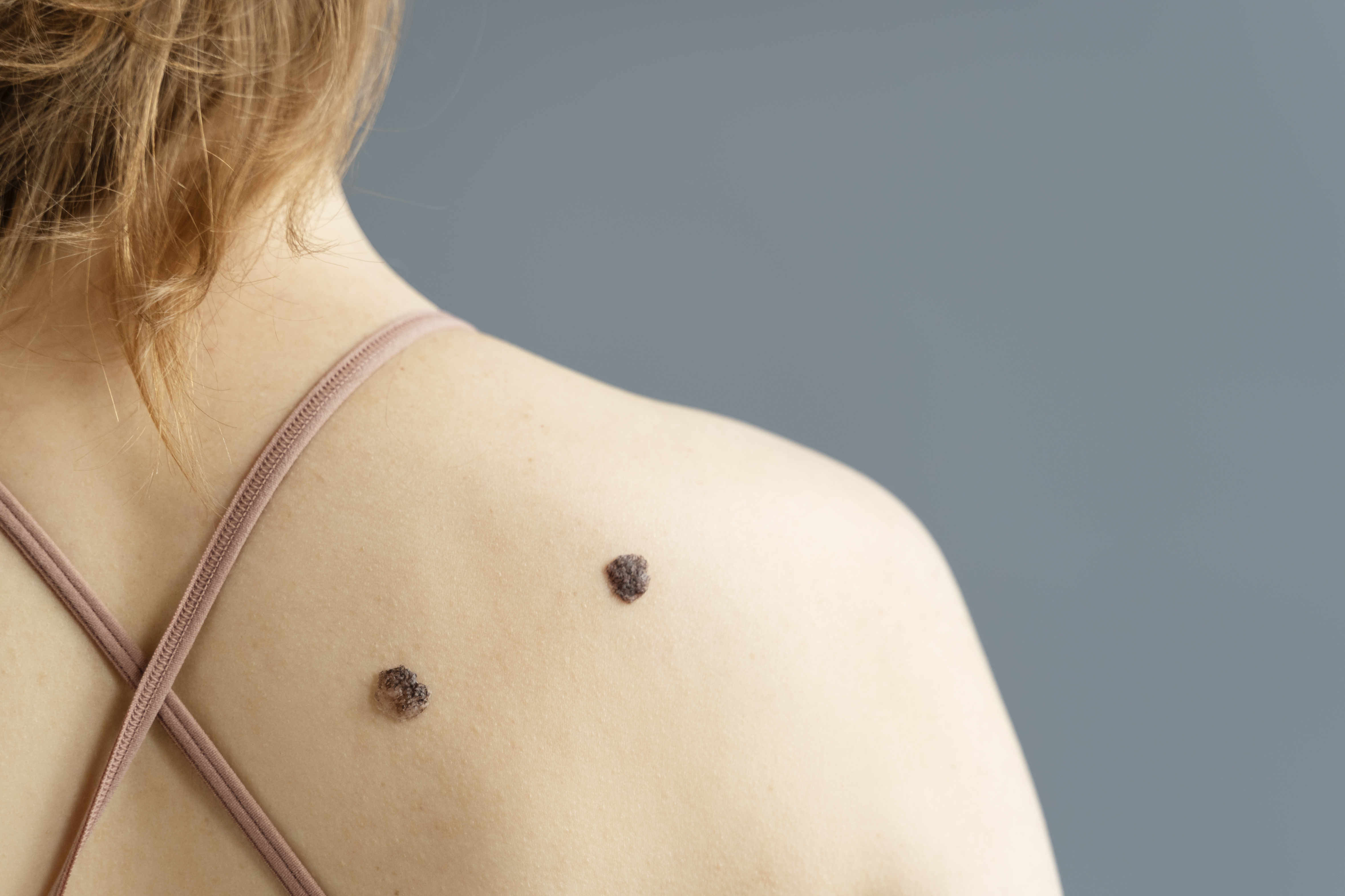 moles