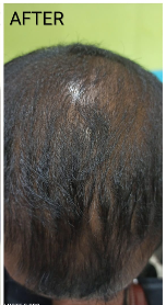 hairfall